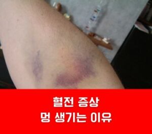 혈전 증상 멍 생기는 이유 혈전 증상 멍 생기는 이유